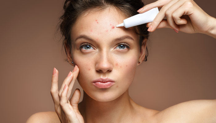 What Is Your Acne Telling You?