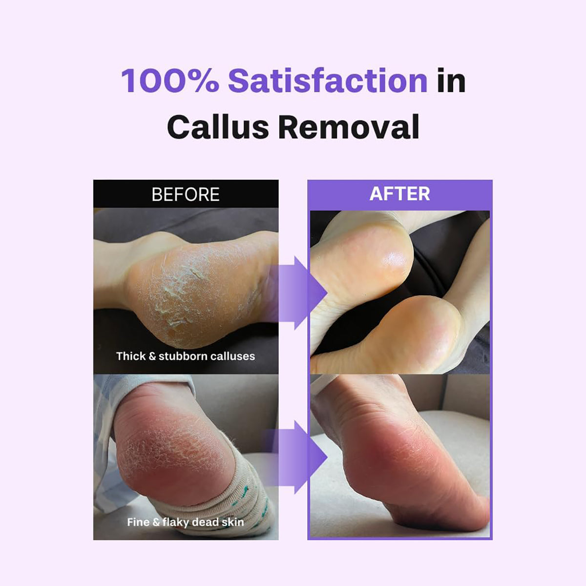 Foot Exfoliant Softener At-Home Kit