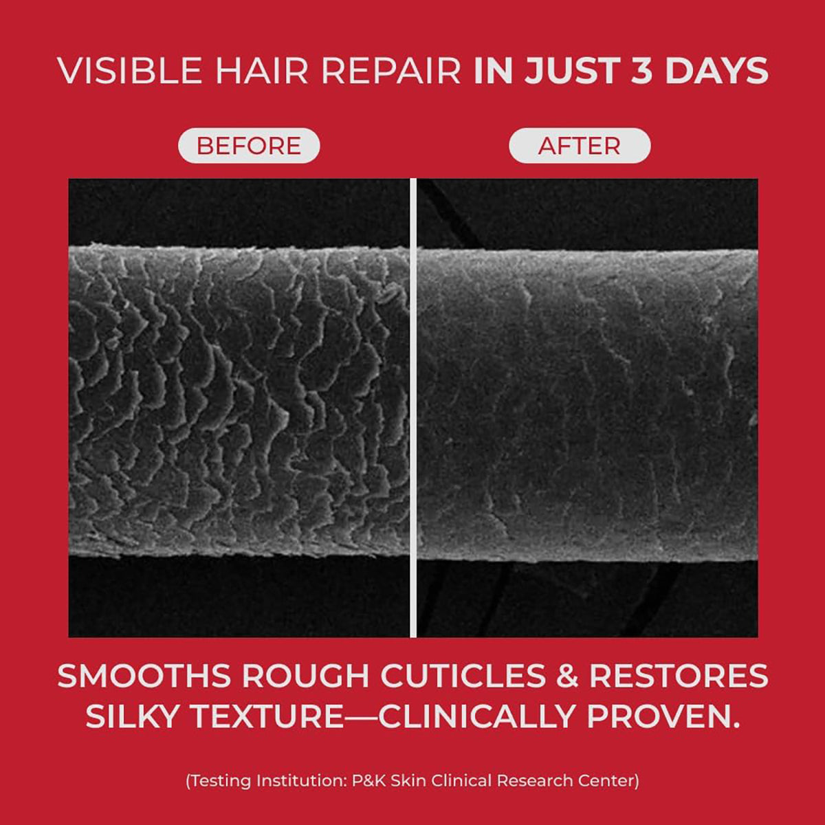 Annurcatin Treatment